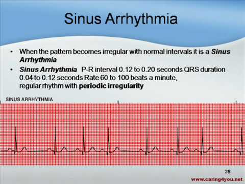 Understanding EKG Strips