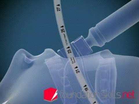 Endotracheal Ventilation in Under 3 Minutes