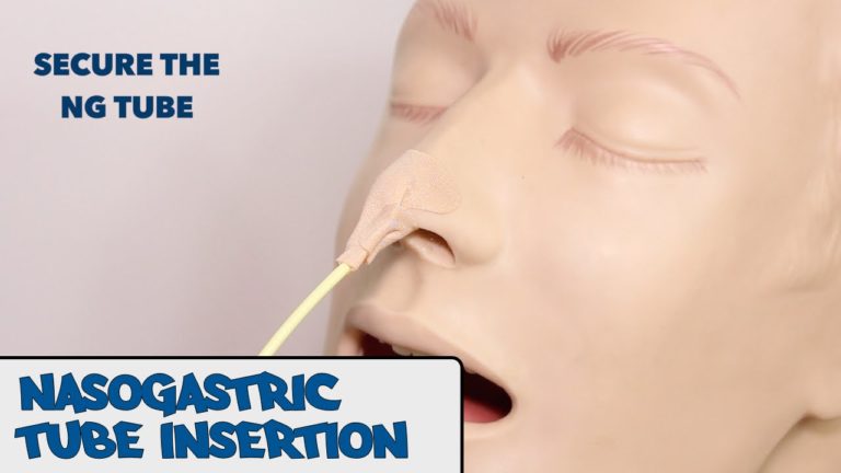 How to Insert a Nasogastric Tube