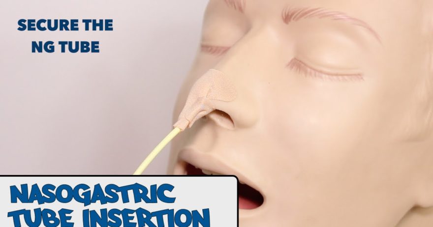 How to Insert a Nasogastric Tube