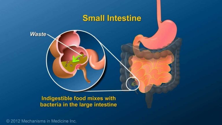 Animation of Ileostomy in Under 5 Minutes