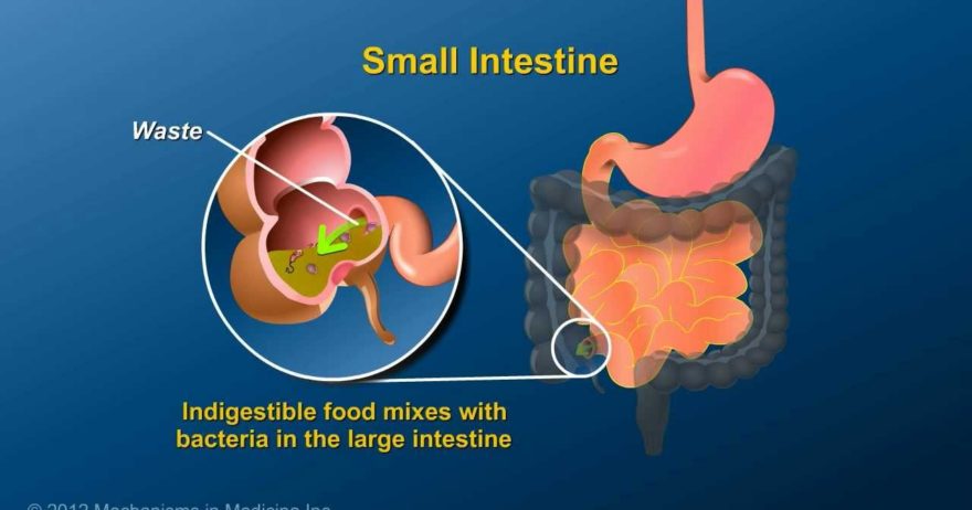 Animation of Ileostomy in Under 5 Minutes
