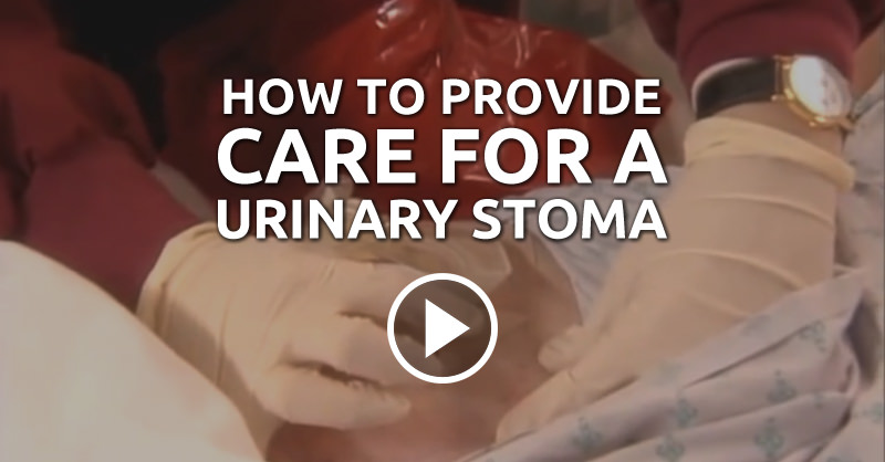 How to Change an Ostomy Pouching System - QD Nurses