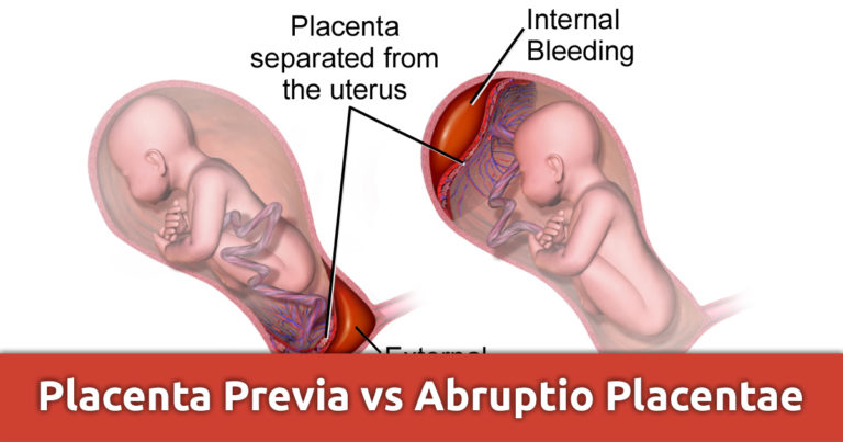 Placenta Previa vs Abruptio Placentae NCLEX Review